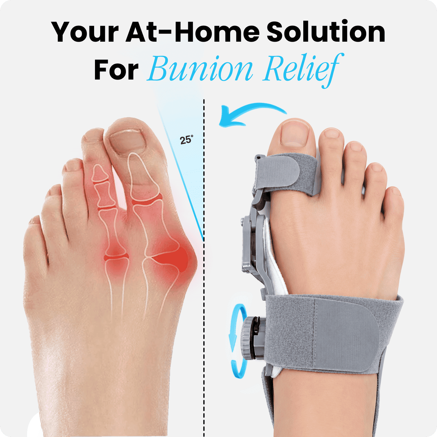 At-Home Solution For Bunion Relief