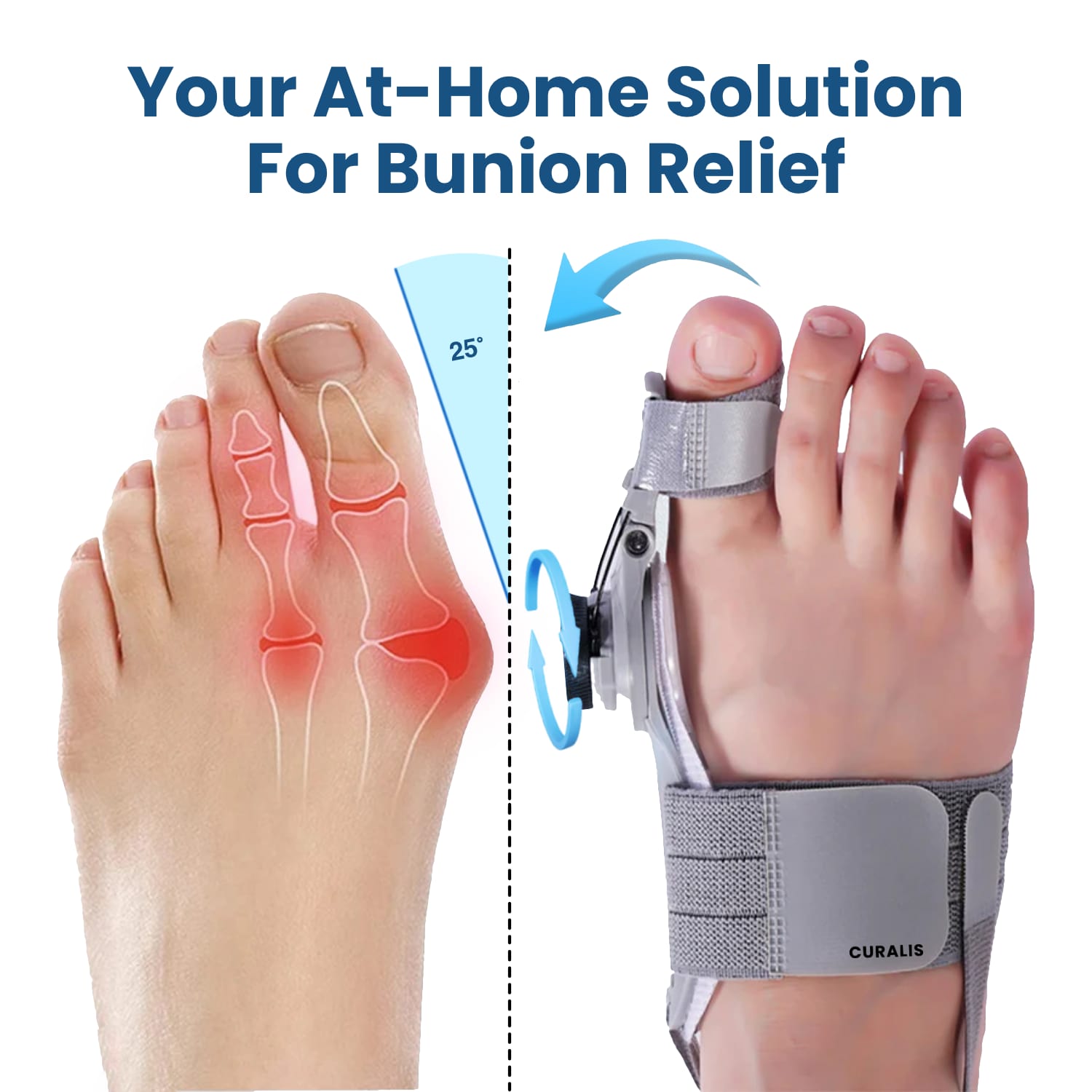 Curalis™ Bunion Relief